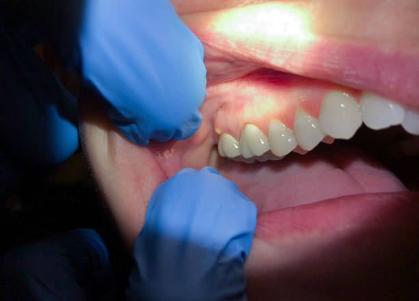 Best Emergency Dental Care for Broken or Chipped Teeth in Ellitt, CO