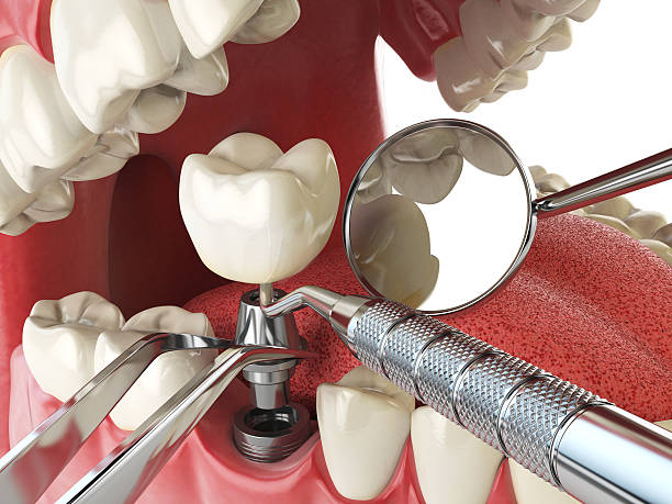 Best Same-Day Emergency Dental Services in Ellitt, CO